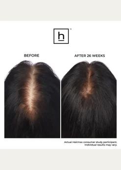 HairmaxLaserBand 82 ComfortFlex Hair Growth Device